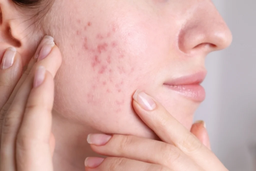 acne & acne scar treatment