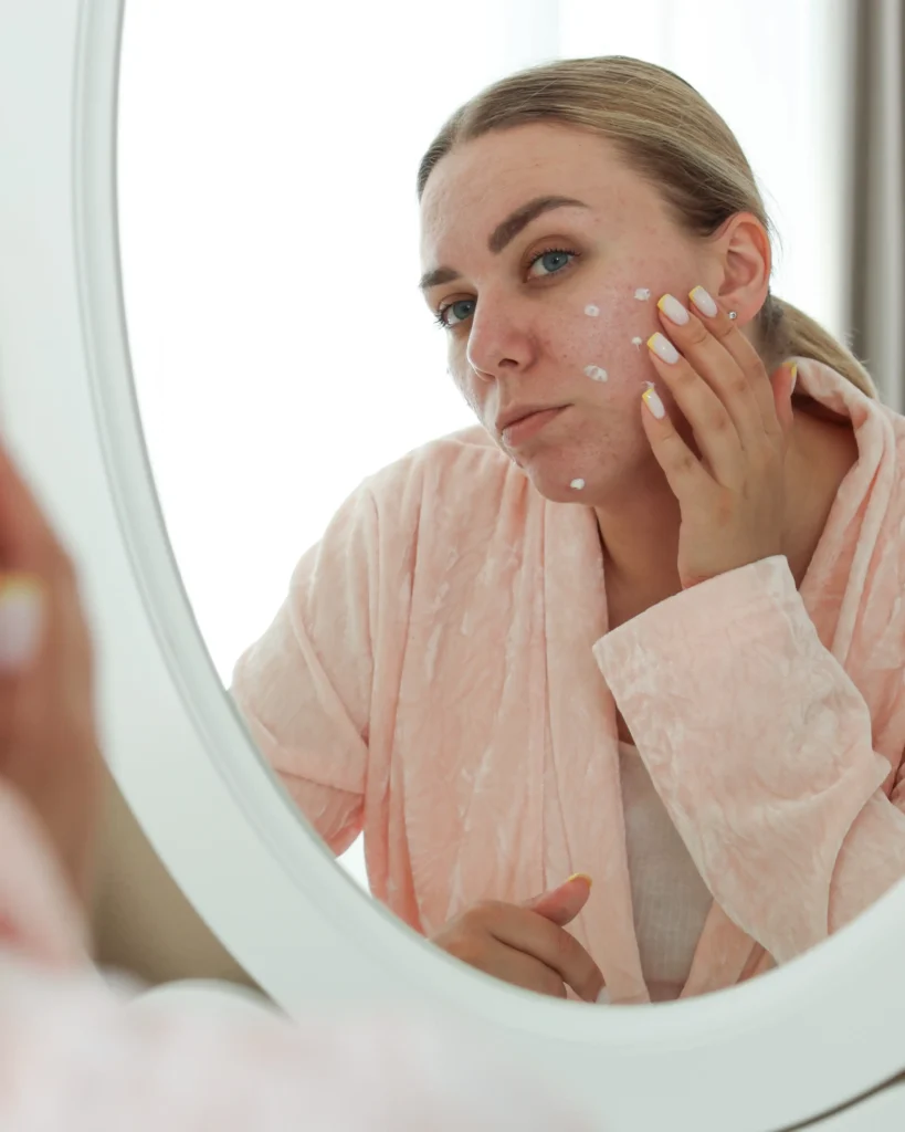 acne treatment in Kochi