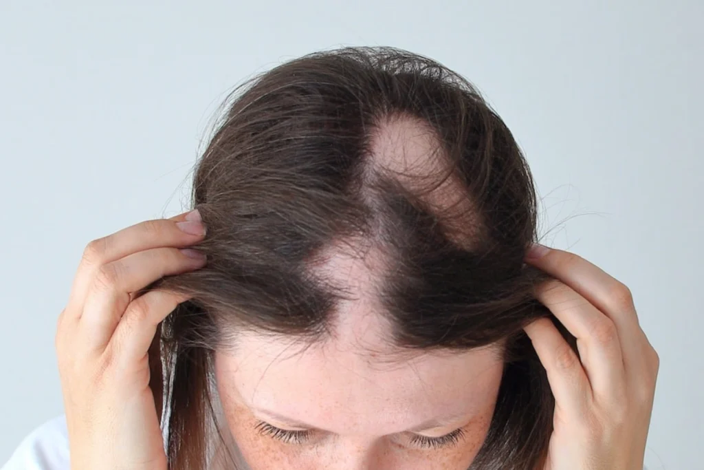 alopecia areata management