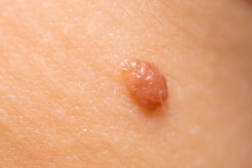 benign skin growth management