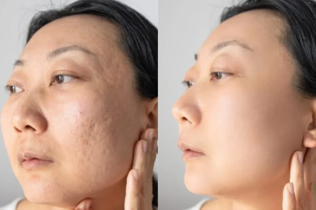 co₂ fractional laser