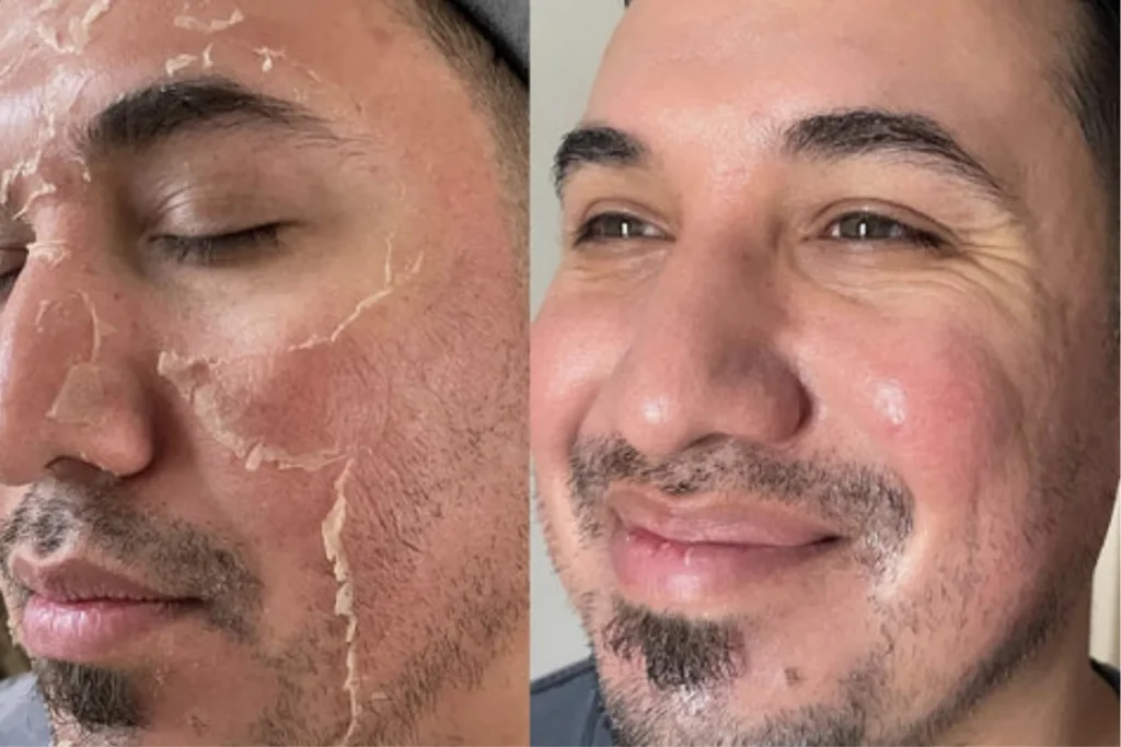 pigmentation treatment in kochi