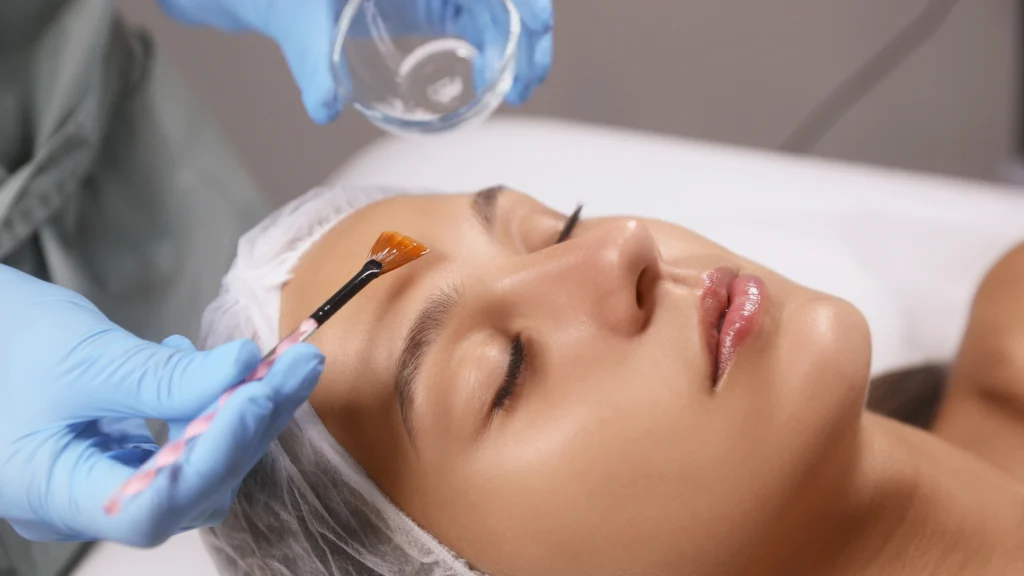 chemical peels