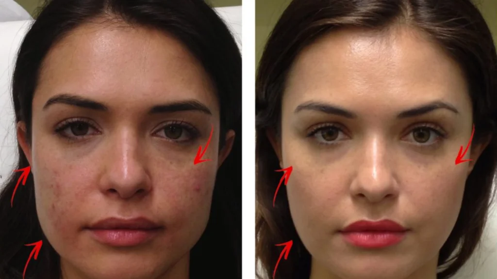 Best acne scar treatment in kochi