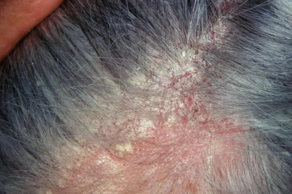 dry scalp and seborrheic dermatitis