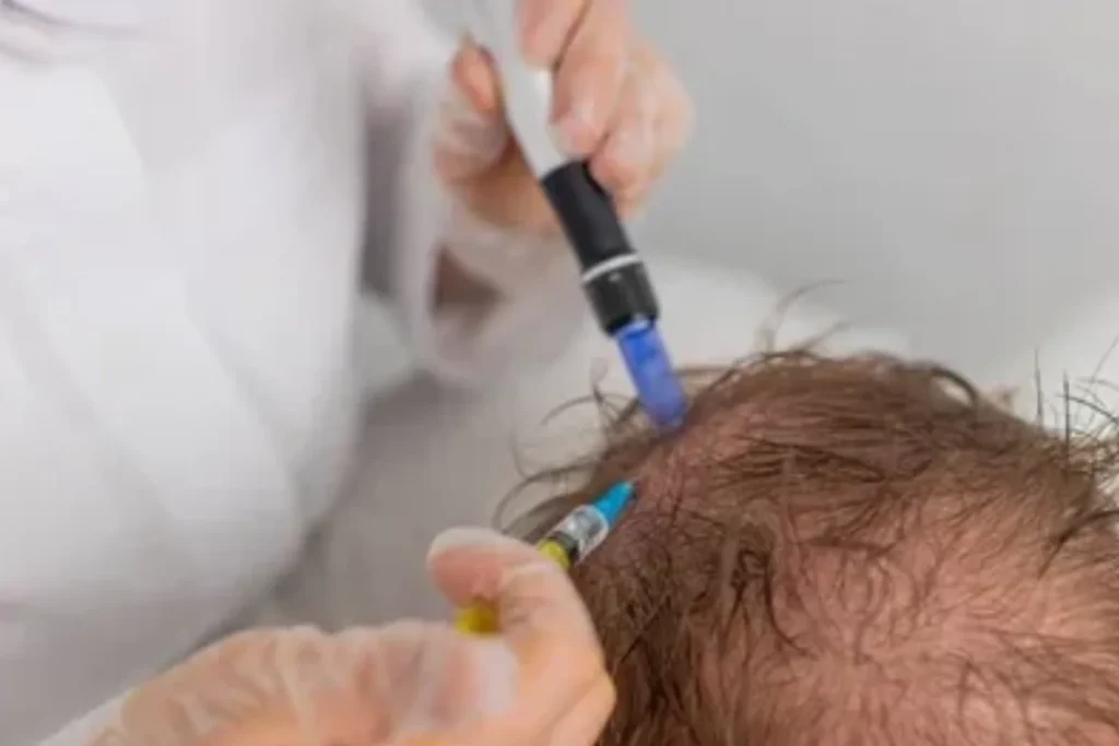 dutexome for hair loss treatment in Kochi