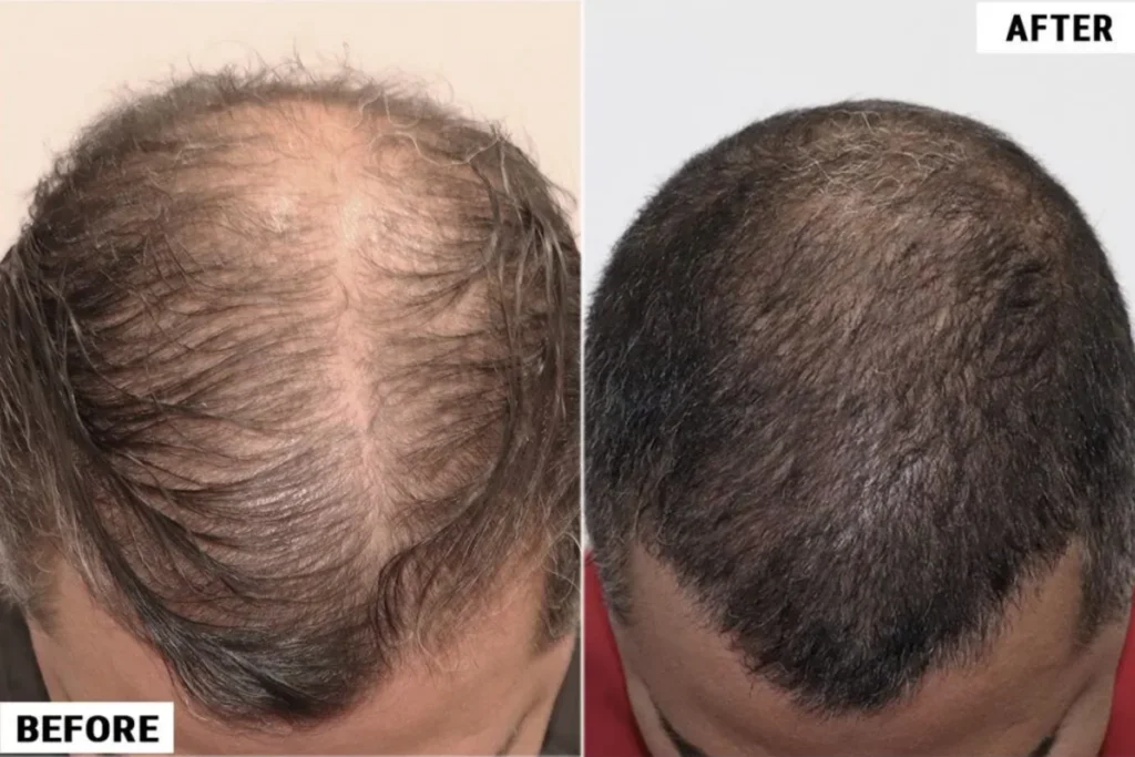 exosomes and Gfc treatment in kochi