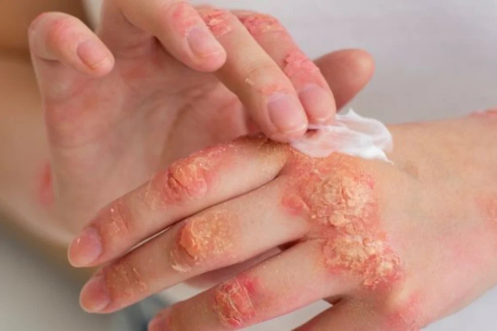 fungal, bacterial, viral, and parasitic infections