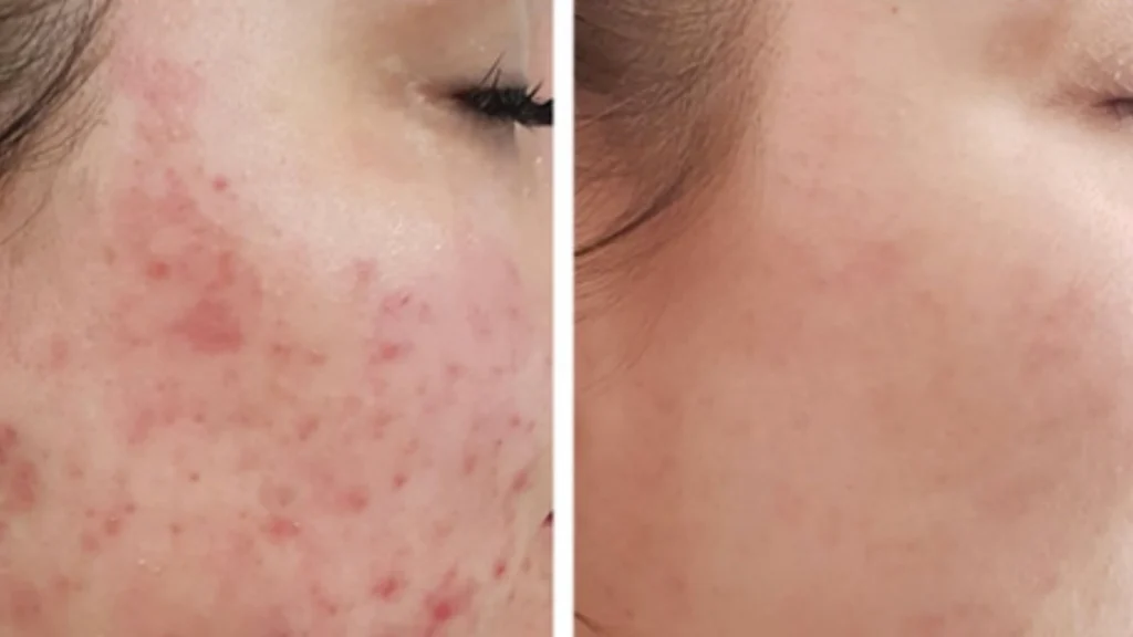 Acne Treatment in Kochi