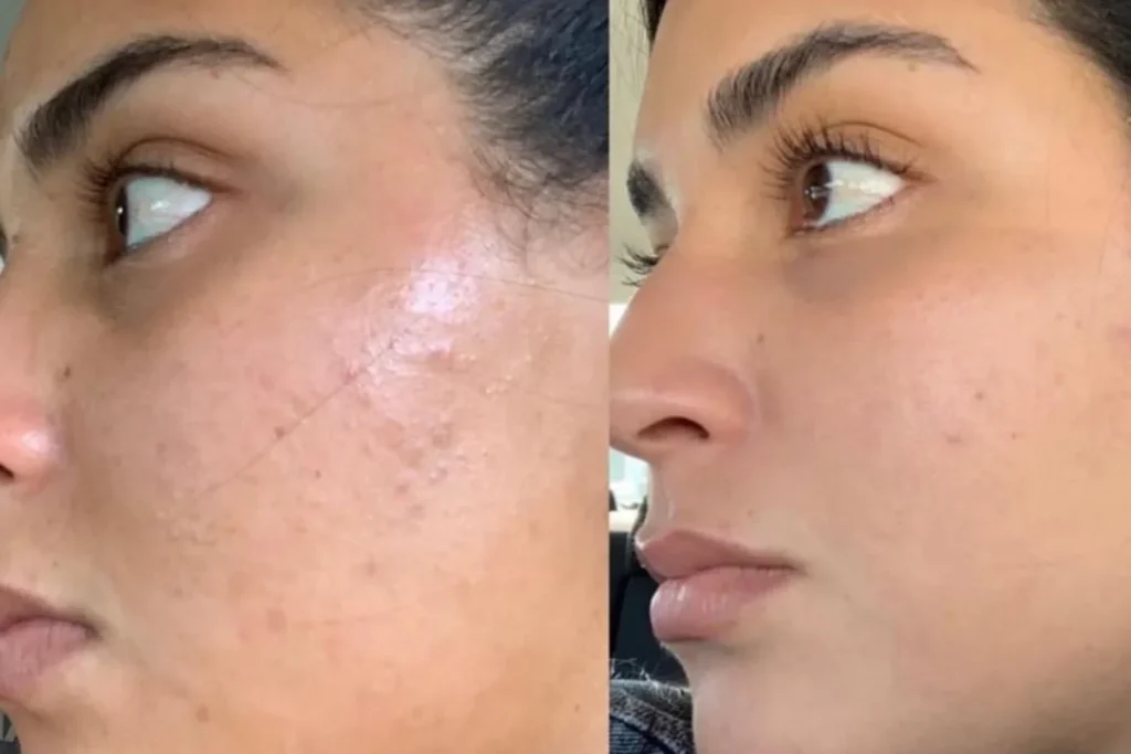 glutathione peel — targeted surface renewal