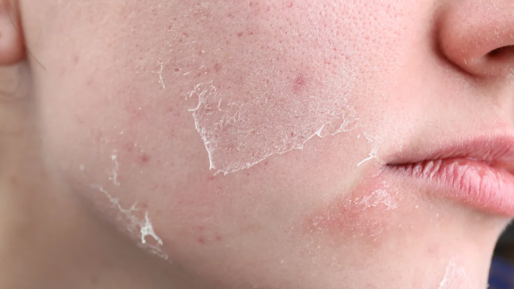 Acne Treatment in Kochi