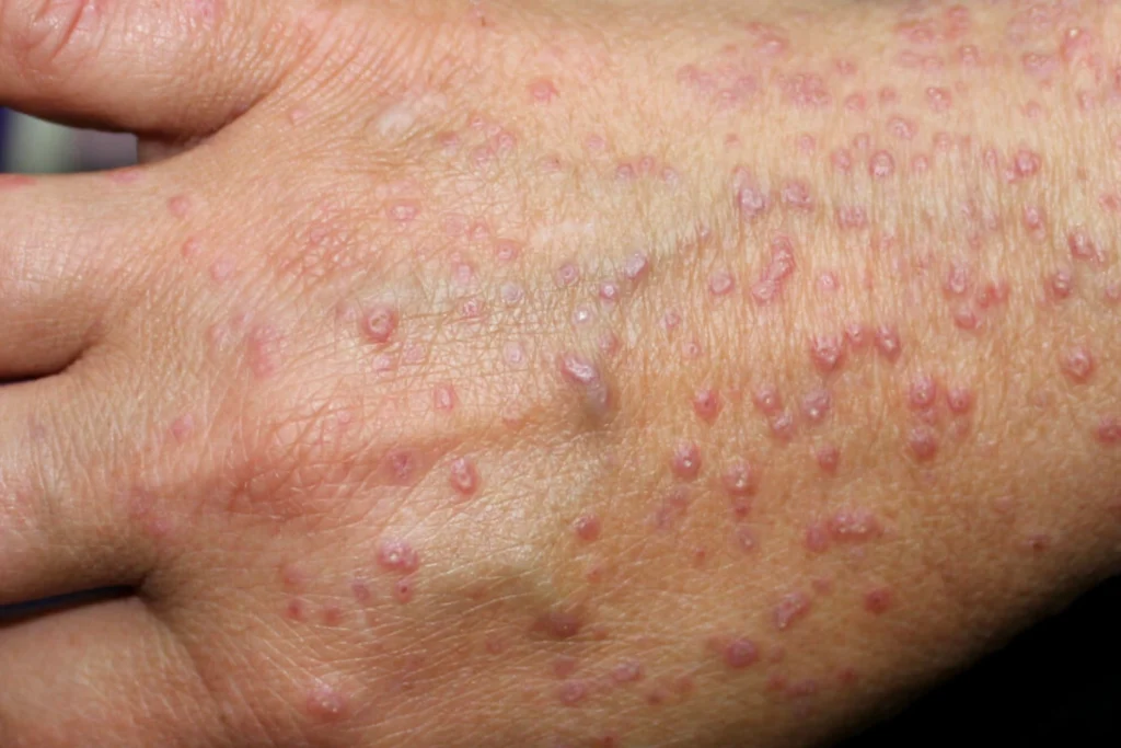 lichen planus & chronic disorders