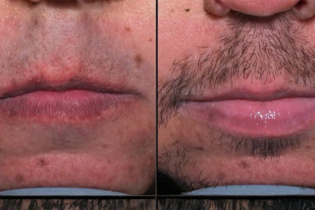 Lip pigmentation treatment in kochi