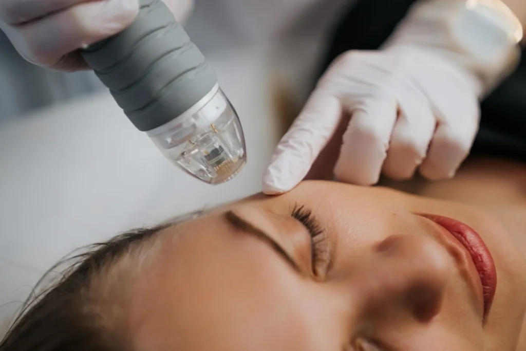 mnrf (microneedling radiofrequency)
