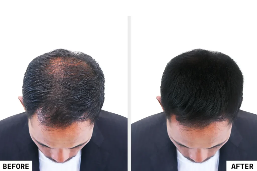 hair fall treatment in kochi