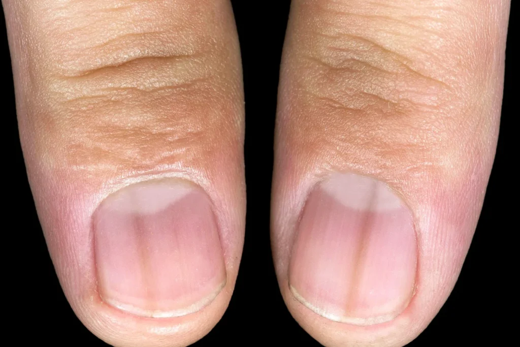 nail pigmentation evaluation