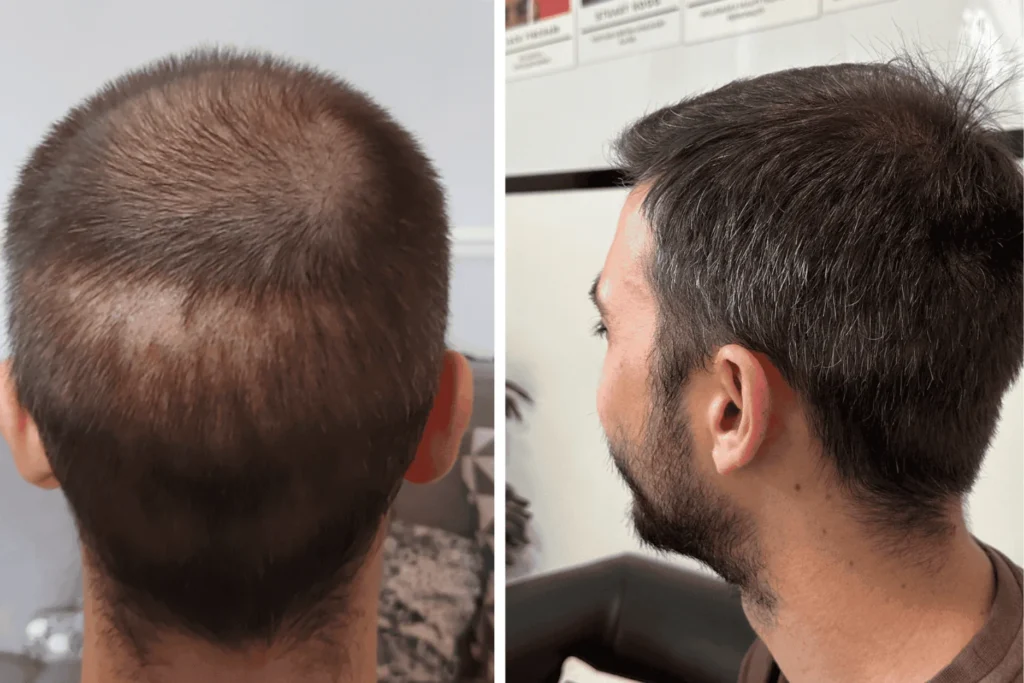 prp (platelet rich plasma) hair treatments in kochi