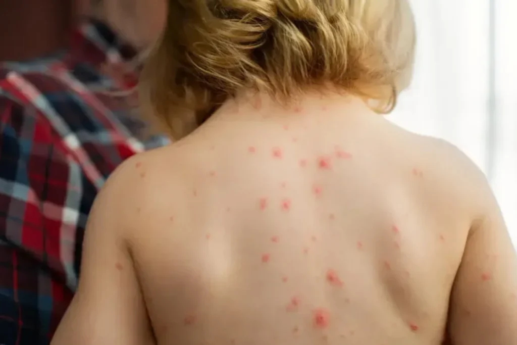 pediatric infections and rashes