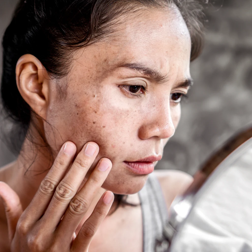 pigmentation treatment in kochi