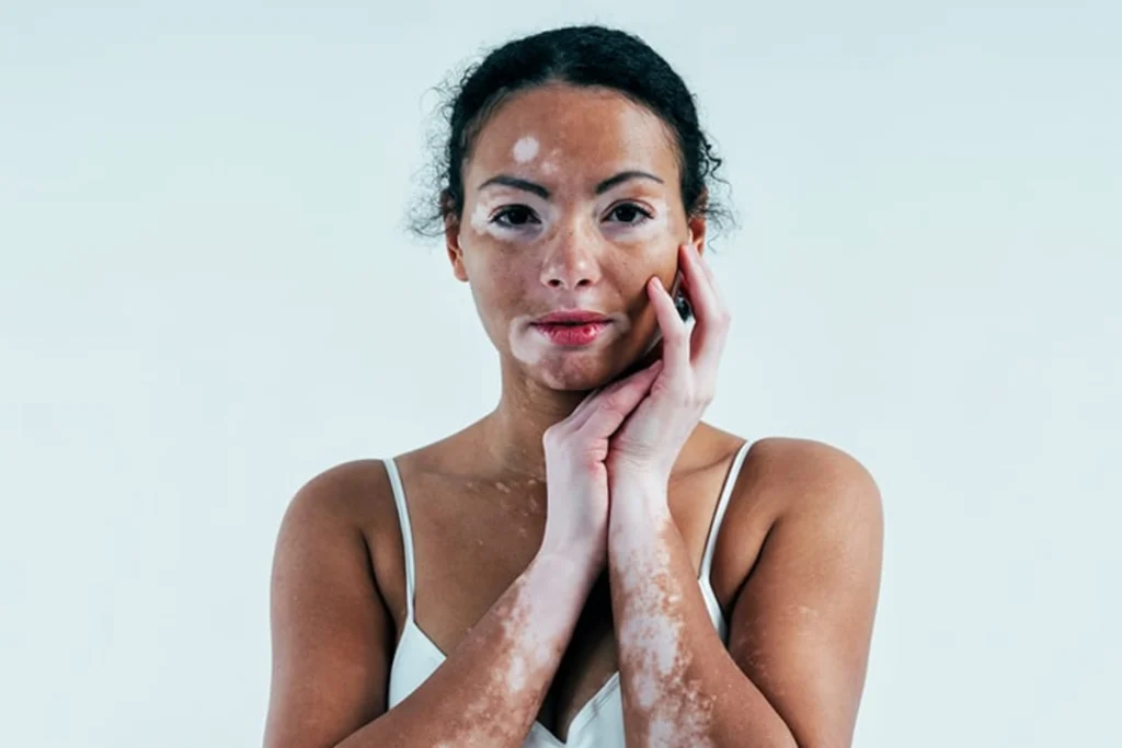 pigmentation disorders