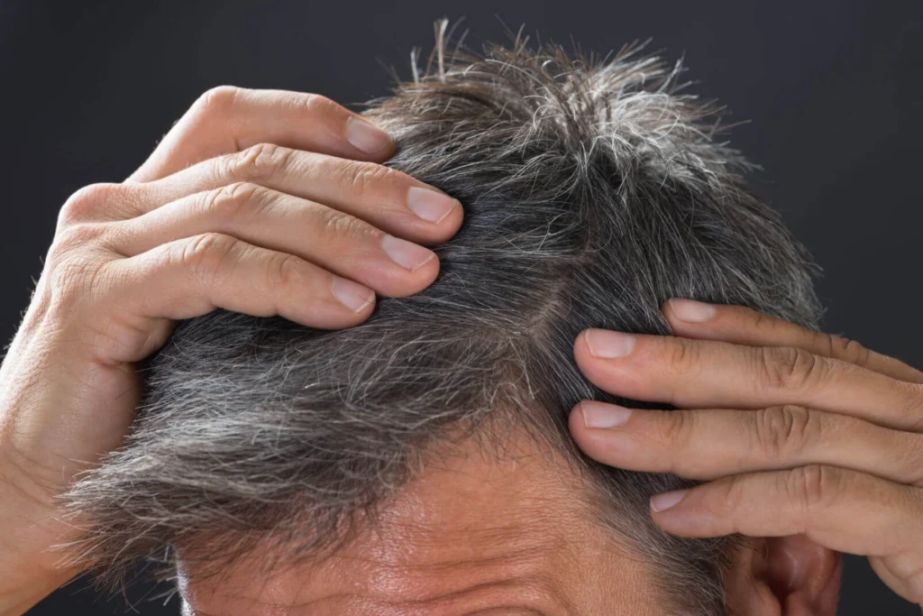 premature greying treatment & scalp infections