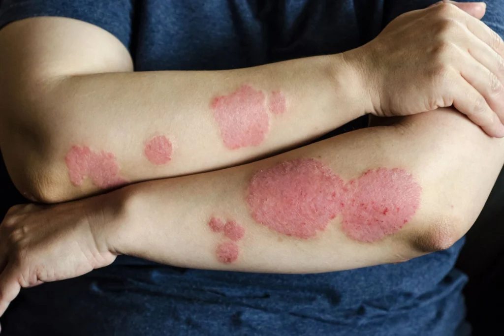 psoriasis management