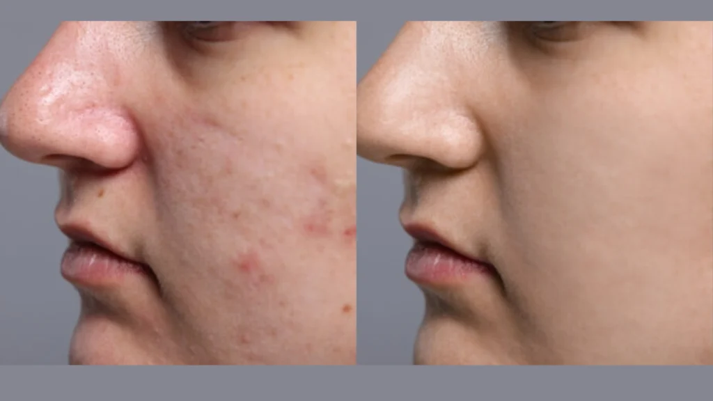 Best acne scar treatment in kochi