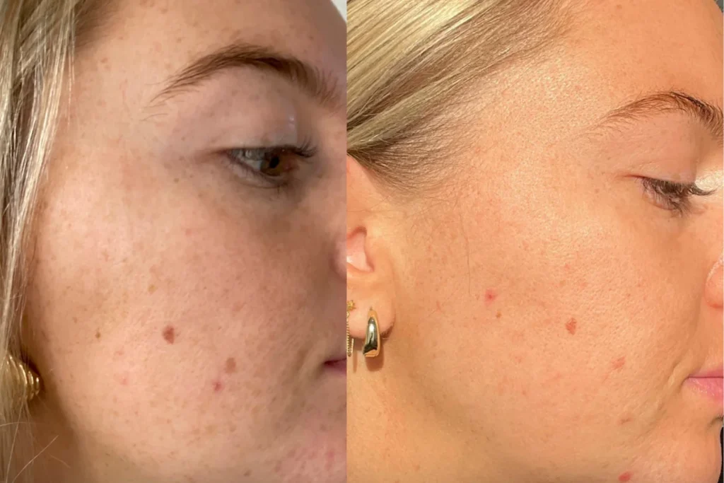 skin brightening peel — deeper tone work