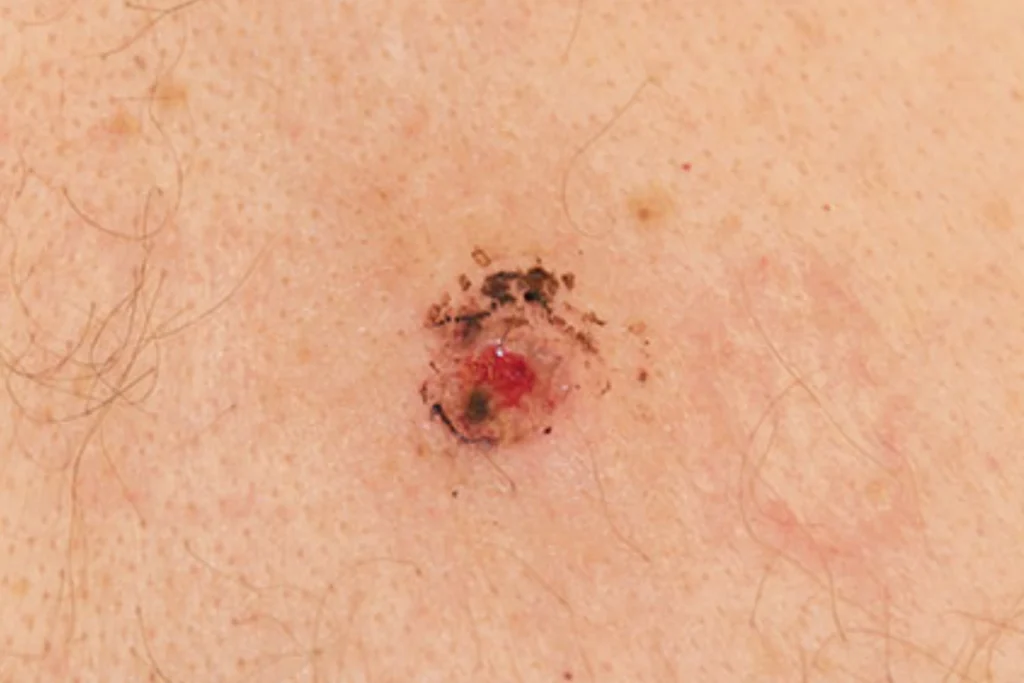 skin growth and lesion removal
