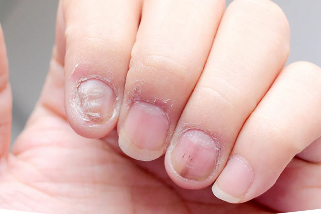thin, brittle nails and nail dystrophies