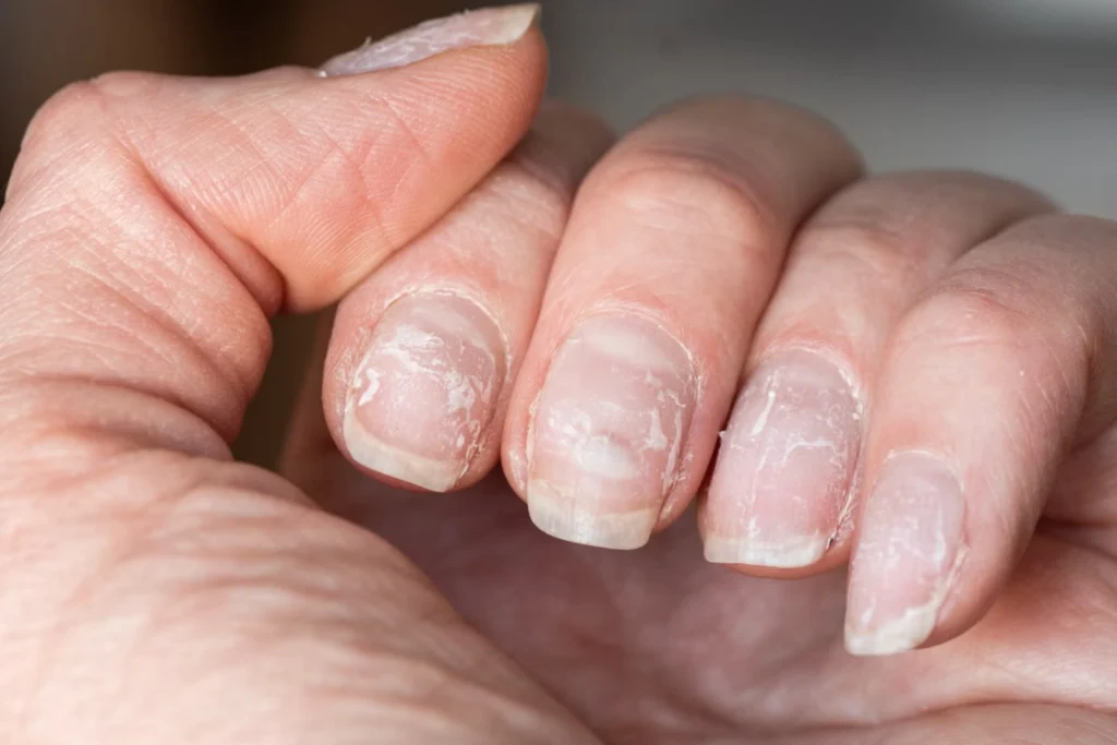 thin, brittle nails and nail dystrophies (2)