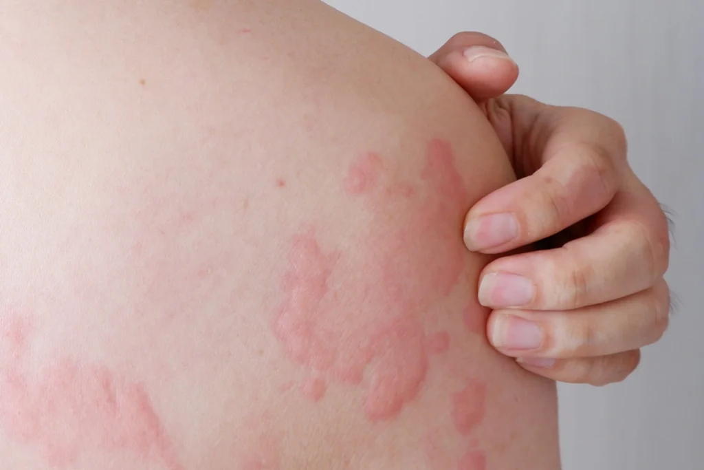 urticaria & allergic rashes