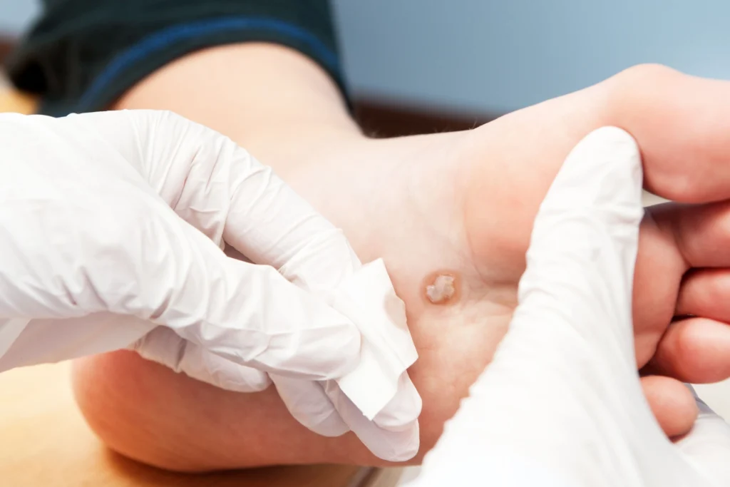wart, skin tag, corn and callus removal