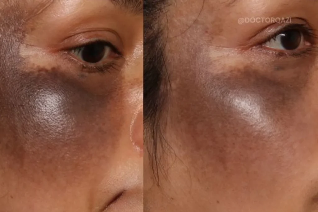 laser treatment kochi