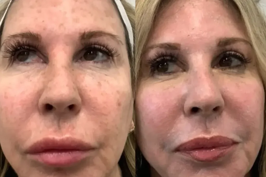 laser treatment kochi