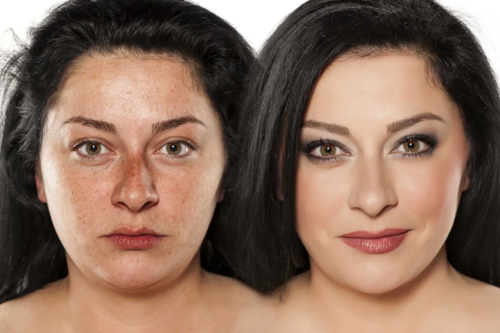 laser treatment kochi