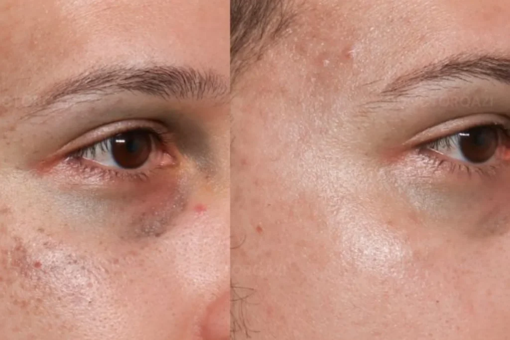 laser treatment kochi