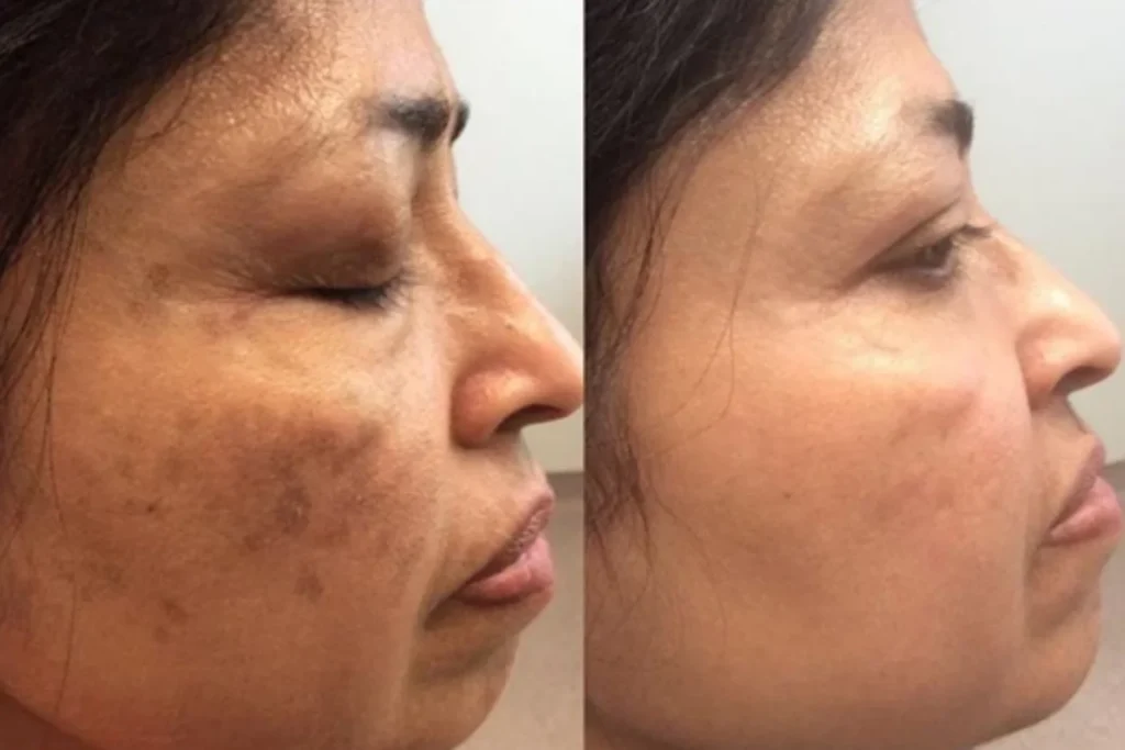 laser treatment kochi