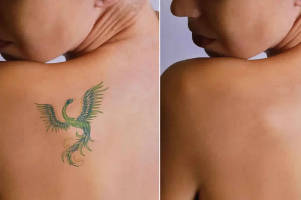 laser treatment kochi