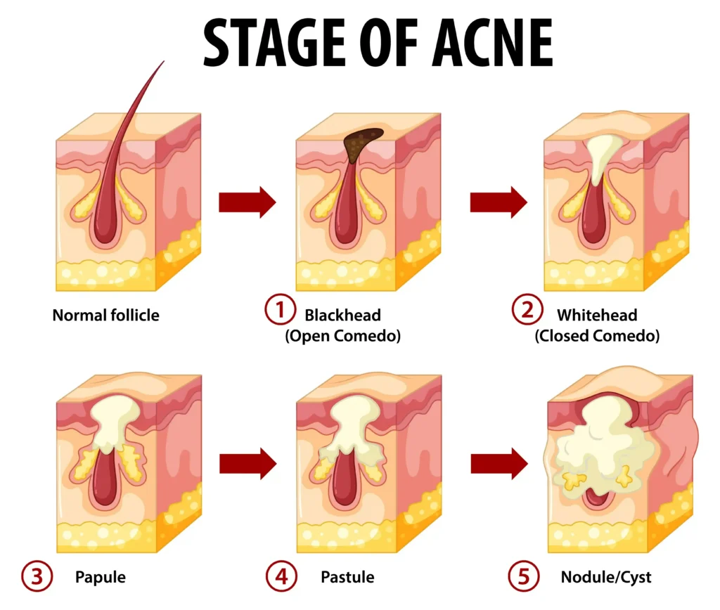 Types of Acne